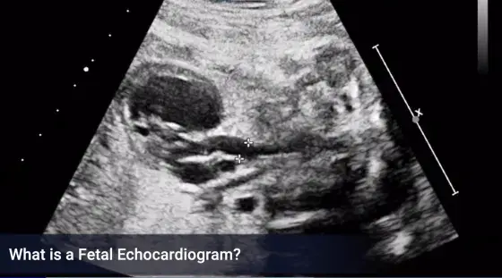 fetal echocardiogram
