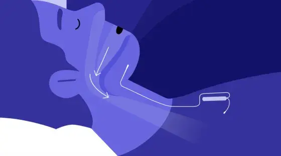 Screenshot of an animated video showing how Inspire Therapy works, with a cartoon patient lying asleep and arrows illustrating airflow